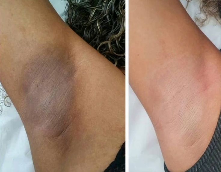 Antes e depois Clarive